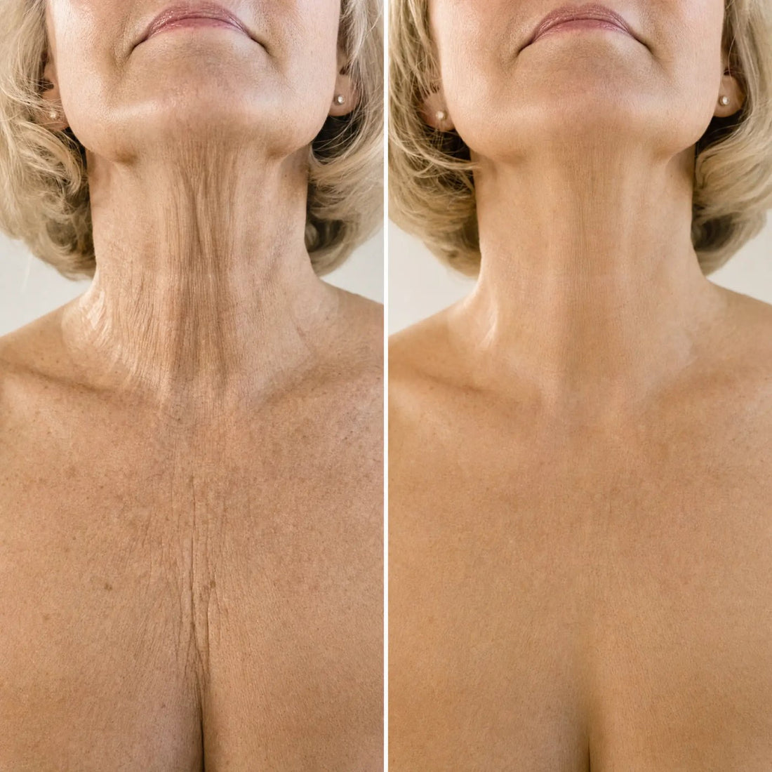 Cuello y escote con piel crepé que se ven más lisos