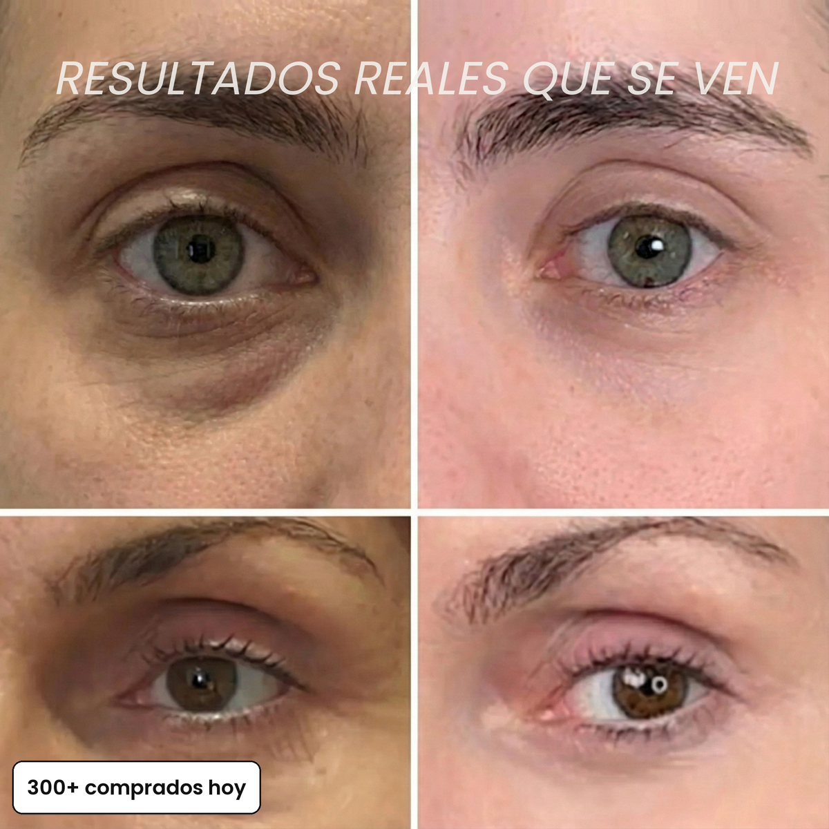 Resultados reales que se ven: antes y después en la zona de los ojos